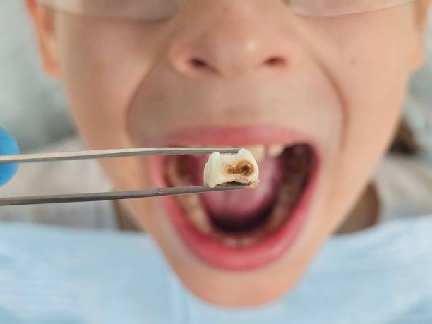 Best Emergency Dentist for Lost Fillings or Crowns in Prosper, TX